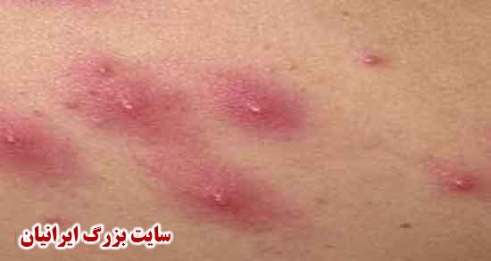 جوش باسن ؛ چگونه باسنی سفید و بدون جوش داشته باشیم