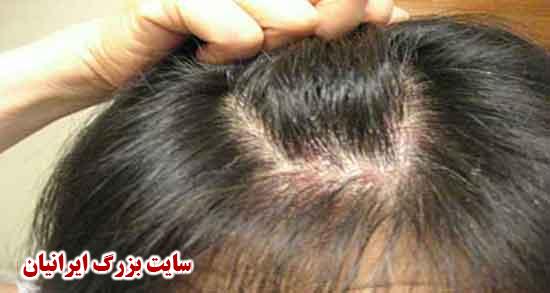 جوش سر ؛ قرص برای جوش سر و علت جوش سر در طب سنتی