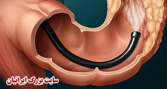 سرطان روده ؛ مهمترین علائم و عمر بیماران و درمان در جوانان چیست