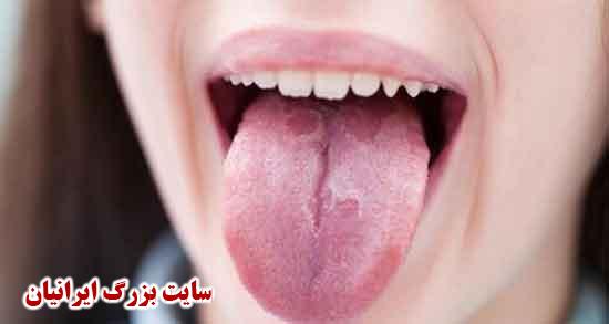 سرطان زبان ؛ عمل جراحی و درمان سرطان زبان با طب سنتی