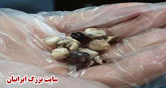 سنگ کیسه صفرا ؛ کپسول و ورزش دفع سنگ کیسه صفرا چیست