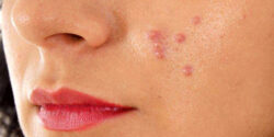 تعبیر خواب جوش روی بازو و روی شانه و دانه های قرمز روی صورت و جوش روی سر و در چشم