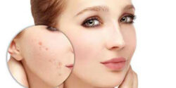 تعبیر خواب چرک جوش روی دست و روی چانه و روی کمر دیگران و روی بدن و جوش سیاه