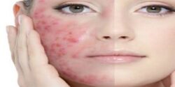 خواص عناب برای جوش و رحم و خواص شیره عناب و زرشک برای کبد