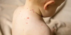 تعبیر خواب آبله مرغان گرفتن + آبله مرغان و خارش شدید و جای زخم آبله مرغان