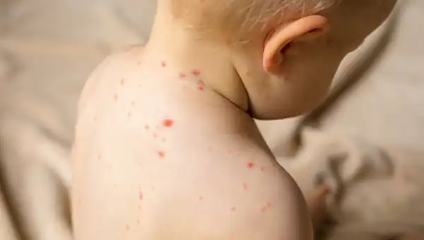 تعبیر خواب آبله مرغان گرفتن + آبله مرغان و خارش شدید و جای زخم آبله مرغان