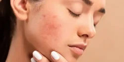 تعبیر خواب دانه روی صورت + مخفی کردن دانه روی صورت و درمان دانه روی صورت