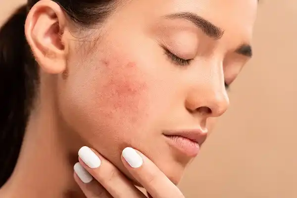 تعبیر خواب دانه روی صورت + مخفی کردن دانه روی صورت و درمان دانه روی صورت