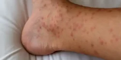 تعبیر خواب کهیر + کهیر خارش دار و کهیر در دست و پا و صورت و درمان کهیر