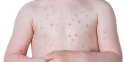 تعبیر خواب کهیر زدن بدن + رفتن به دکتر به خاطر کهیر و مخفی کردن کهیر