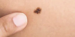تعبیر خواب خال روی بازو + خال از دید امام صادق و خال روی صورت نوزاد