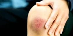 تعبیر خواب کبودی زانو + برای زن متاهل و بادار و دختر مجرد