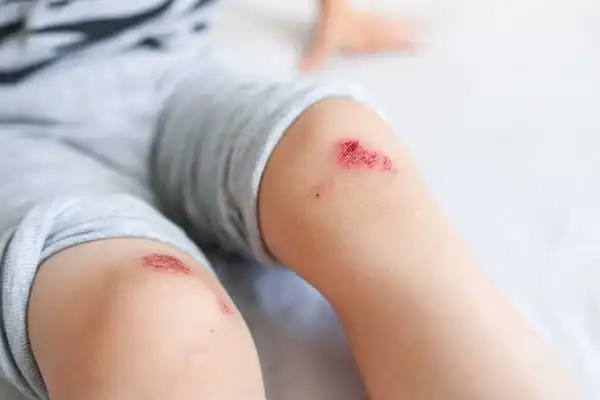 تعبیر خواب زخم زانو + برای زن متاهل و بادار و دختر مجرد