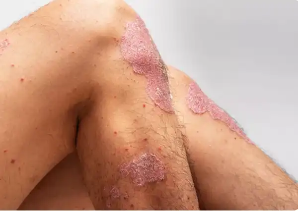 تعبیر خواب زخمی شدن زانو + برای زن متاهل و بادار و دختر مجرد