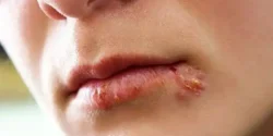تعبیر خواب تاول زدن لب + برای زن متاهل و بادار و دختر مجرد
